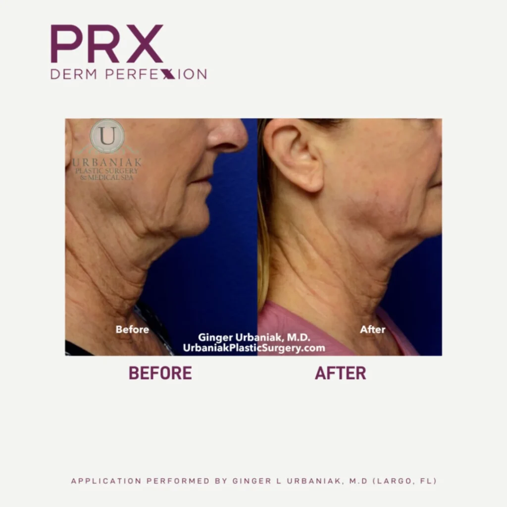Skin Tightening Park City