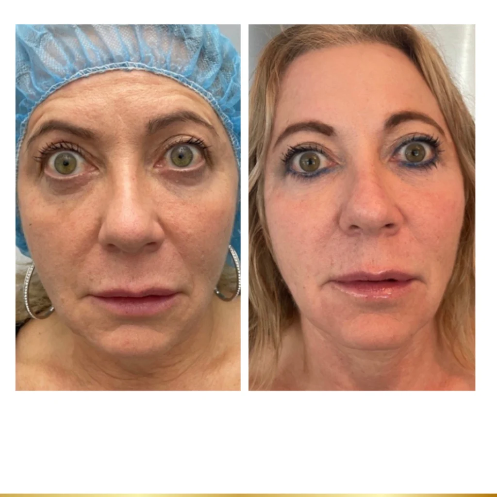 Before and after dermal filler treatment showing improved under eye hollows reduced tear troughs restored cheek volume and more refreshed appearance at Park City Medesthetix
