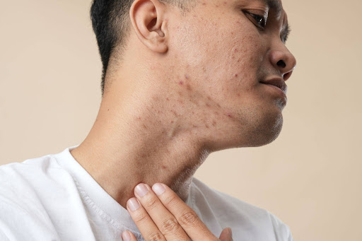 Medical spa acne treatment designed to improve skin texture and reduce blemishes