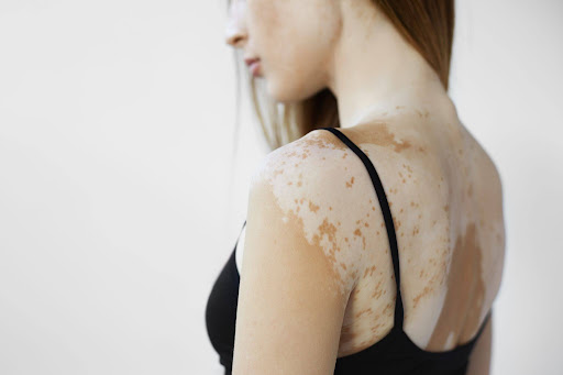 Vitiligo awareness and skin health support provided by experienced aesthetic professionals